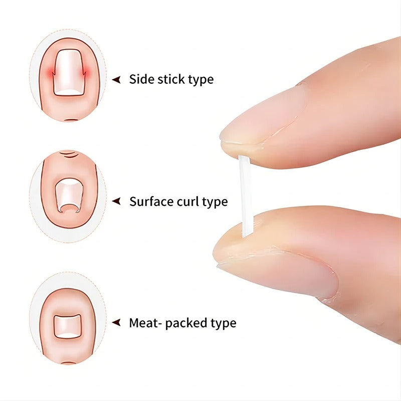 Ingegroeide Teennagel Correctie Kit | Verlicht pijn en corrigeert nagelgroei eenvoudig thuis