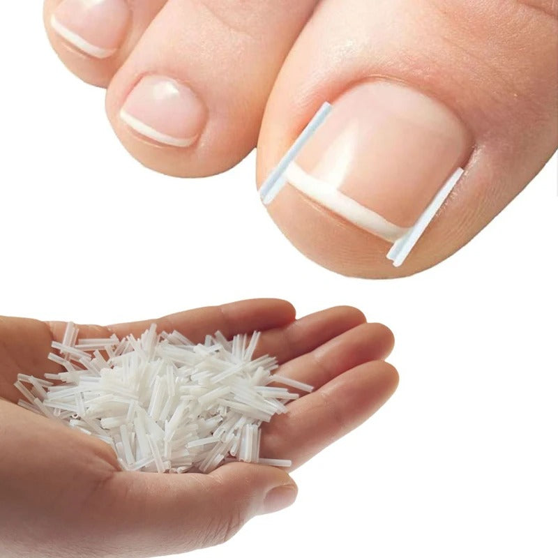 Ingegroeide Teennagel Correctie Kit | Verlicht pijn en corrigeert nagelgroei eenvoudig thuis